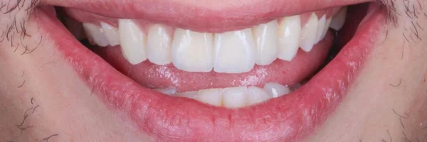 Foto do dente Depois da cirurgia guiada por computador