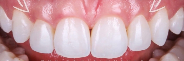 foto de dente após a restauração