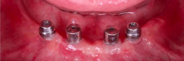 antes da cirurgia de implante dental