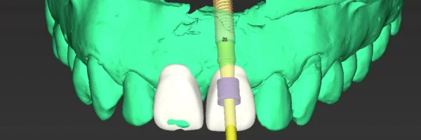 antes da cirurgia guidada por computador para implante dental