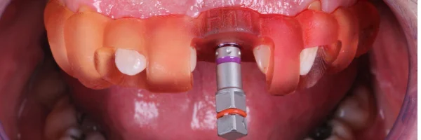 depois da cirurgia guidada por computador para implante dental