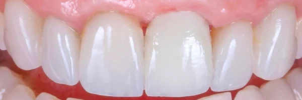 foto depois da cirurgia guidada por computador para implante dental